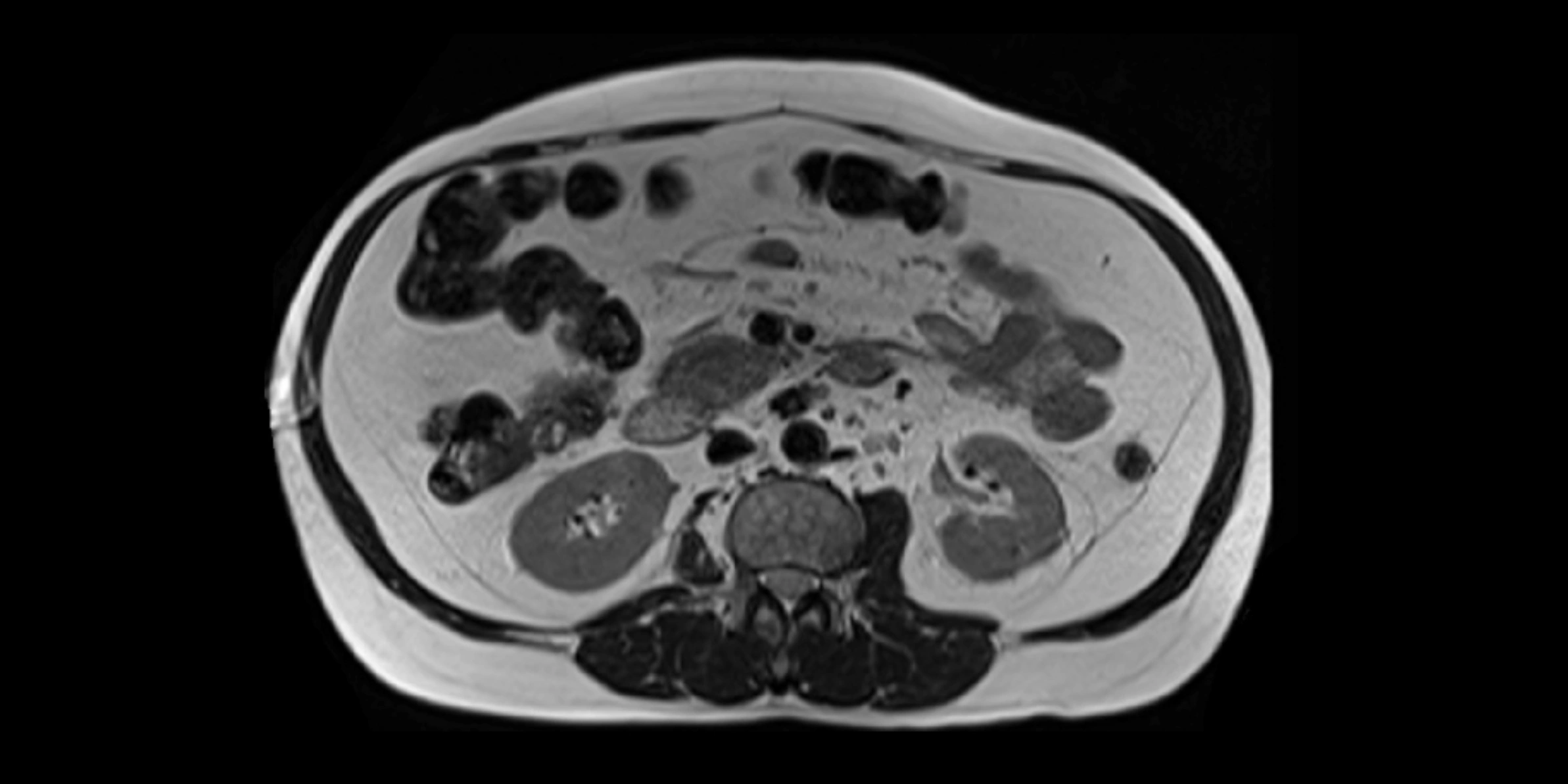 MRI liver lobe axial cross sectional 3T radiology  image-img-00001-00024.webp